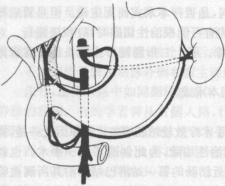 三、Appleby手術(shù)
